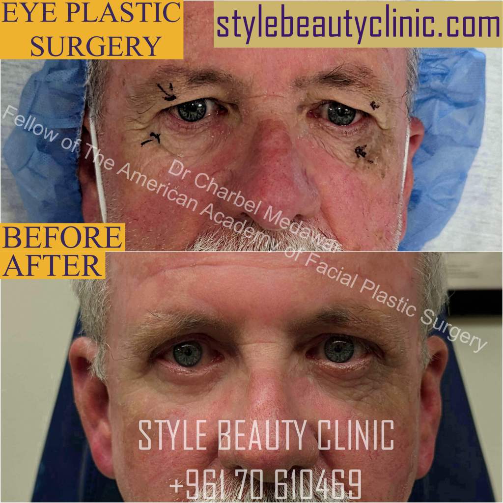 best eye plastic surgery lebanon dr charbel medawar best eye plastic surgery lebanon dr charbel medawar
