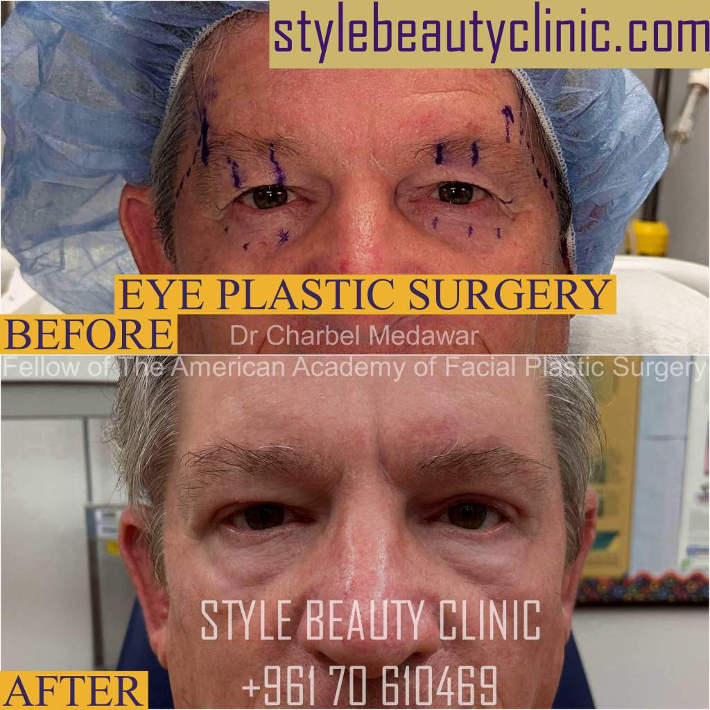 best eyelid plastic surgery lebanon dr charbel medawar best eyelid plastic surgery lebanon dr charbel medawar
