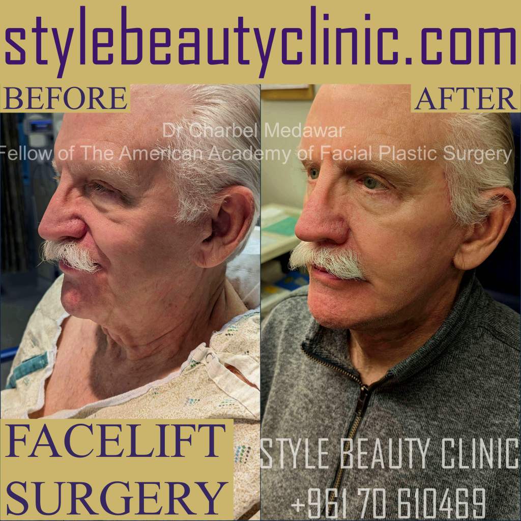 best facelift surgeon in lebanon dr charbel medawar