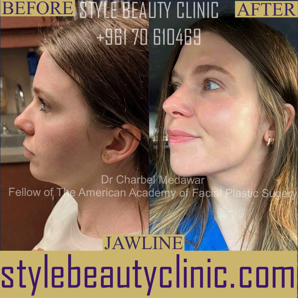 best jawline chin filler contouring plastic surgery beirut lebanon dr charbel medawar