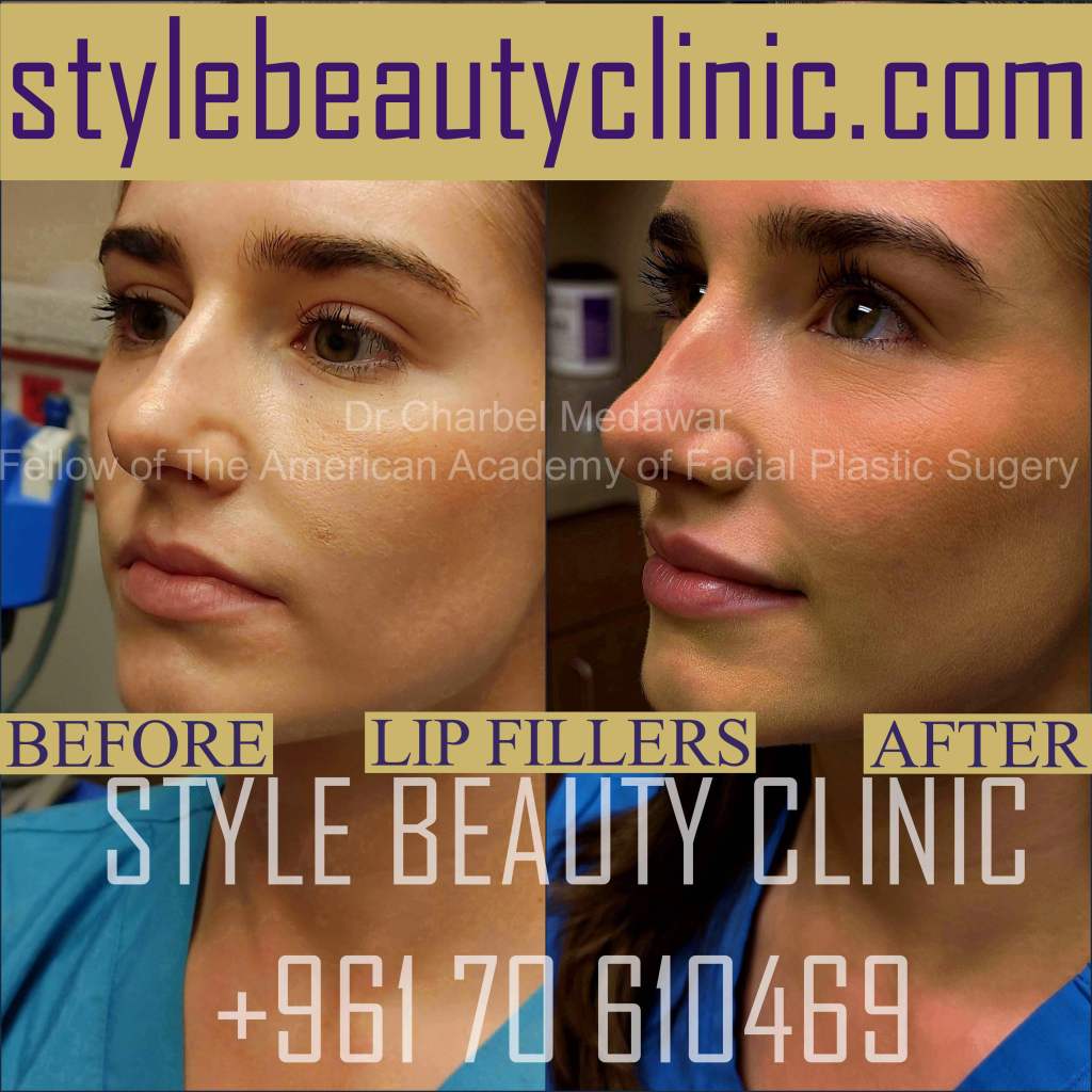 best lip fillers beirut lebanon plastic surgery style beauty clinic dr charbel medawar