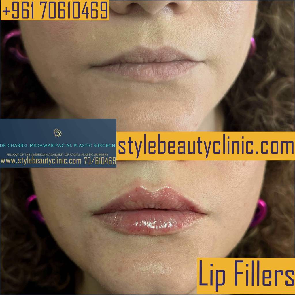 best lip fillers lebanon dr charbel medawar