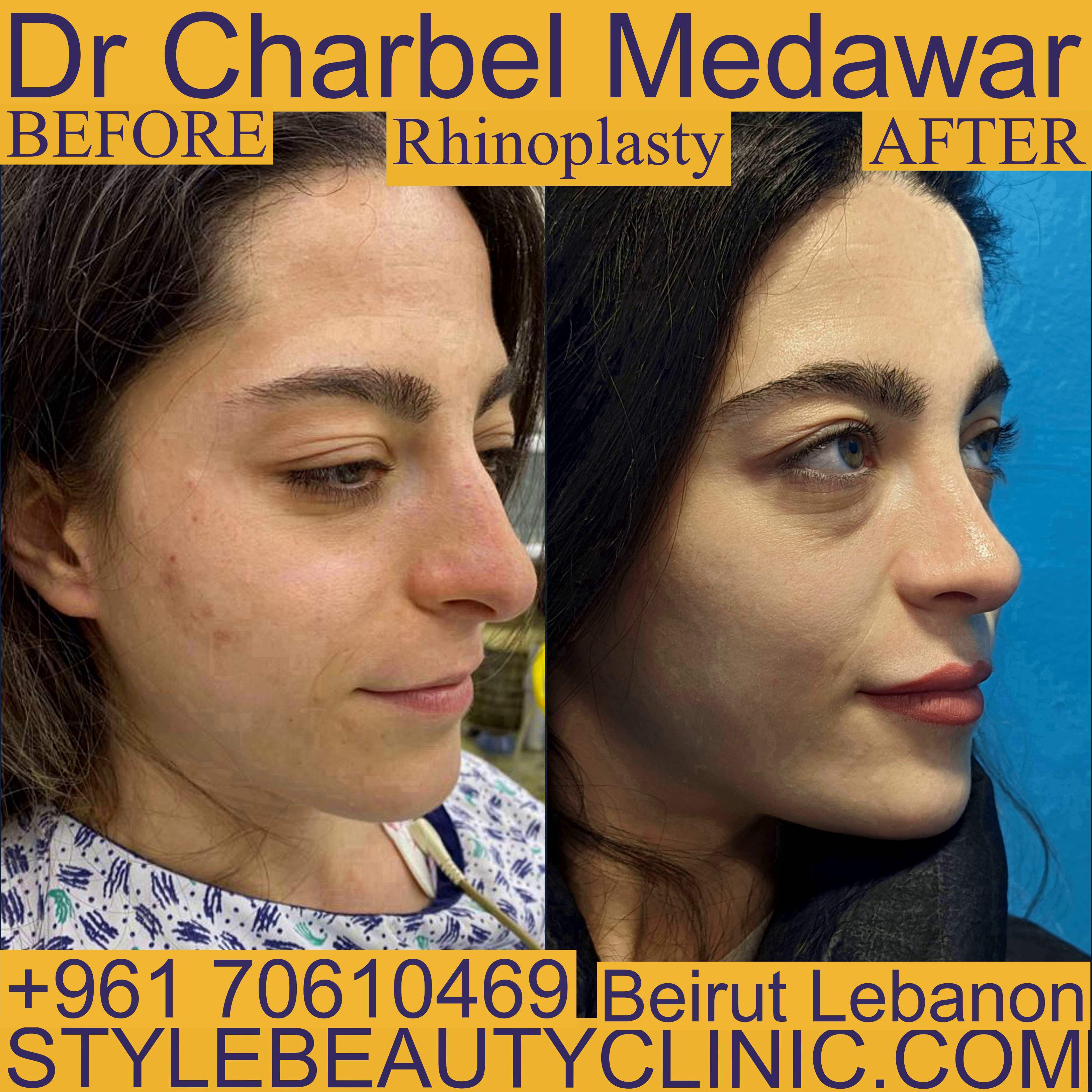 best nose doctor in lebanon charbel medawar