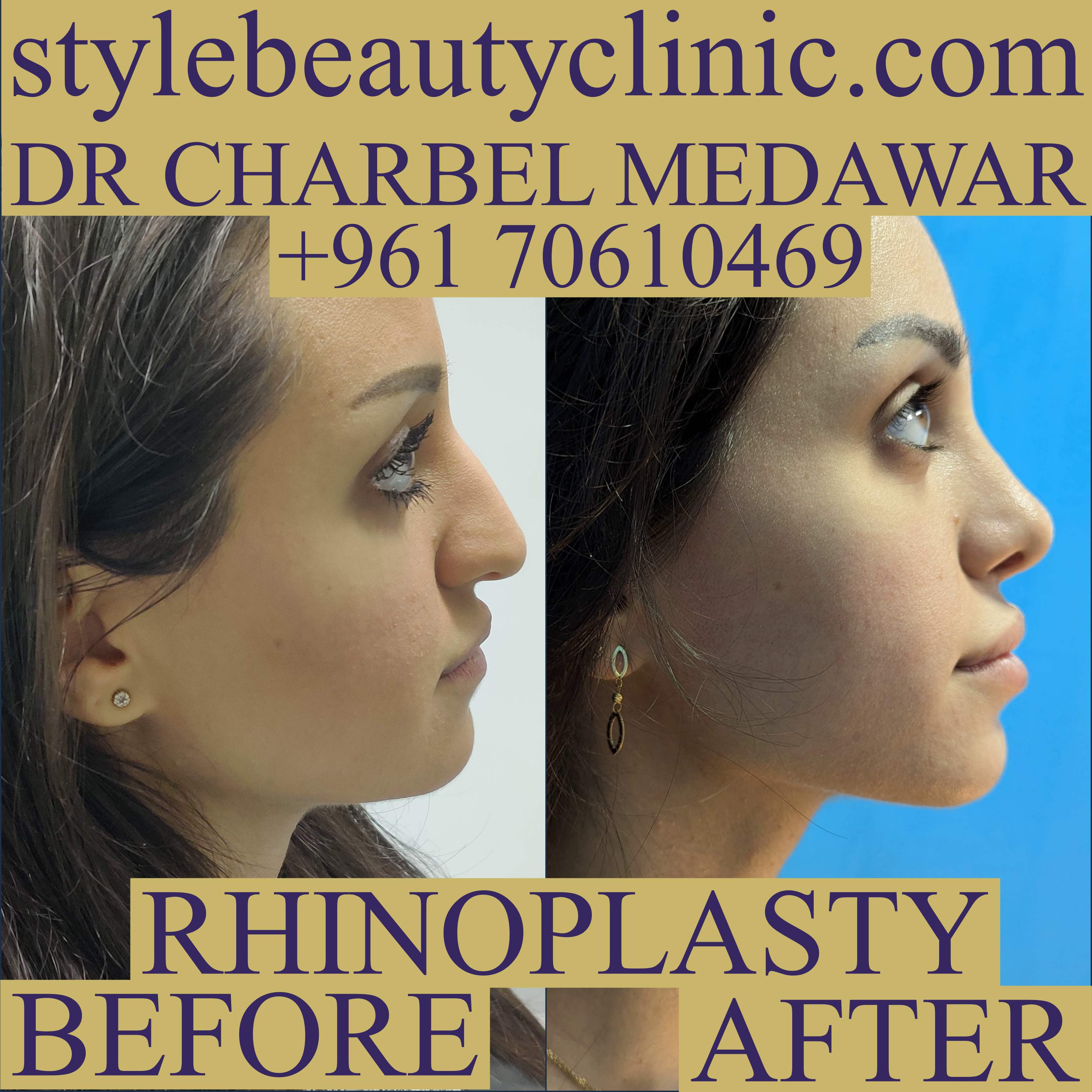 best nose job doctor in lebanon charbel medawar