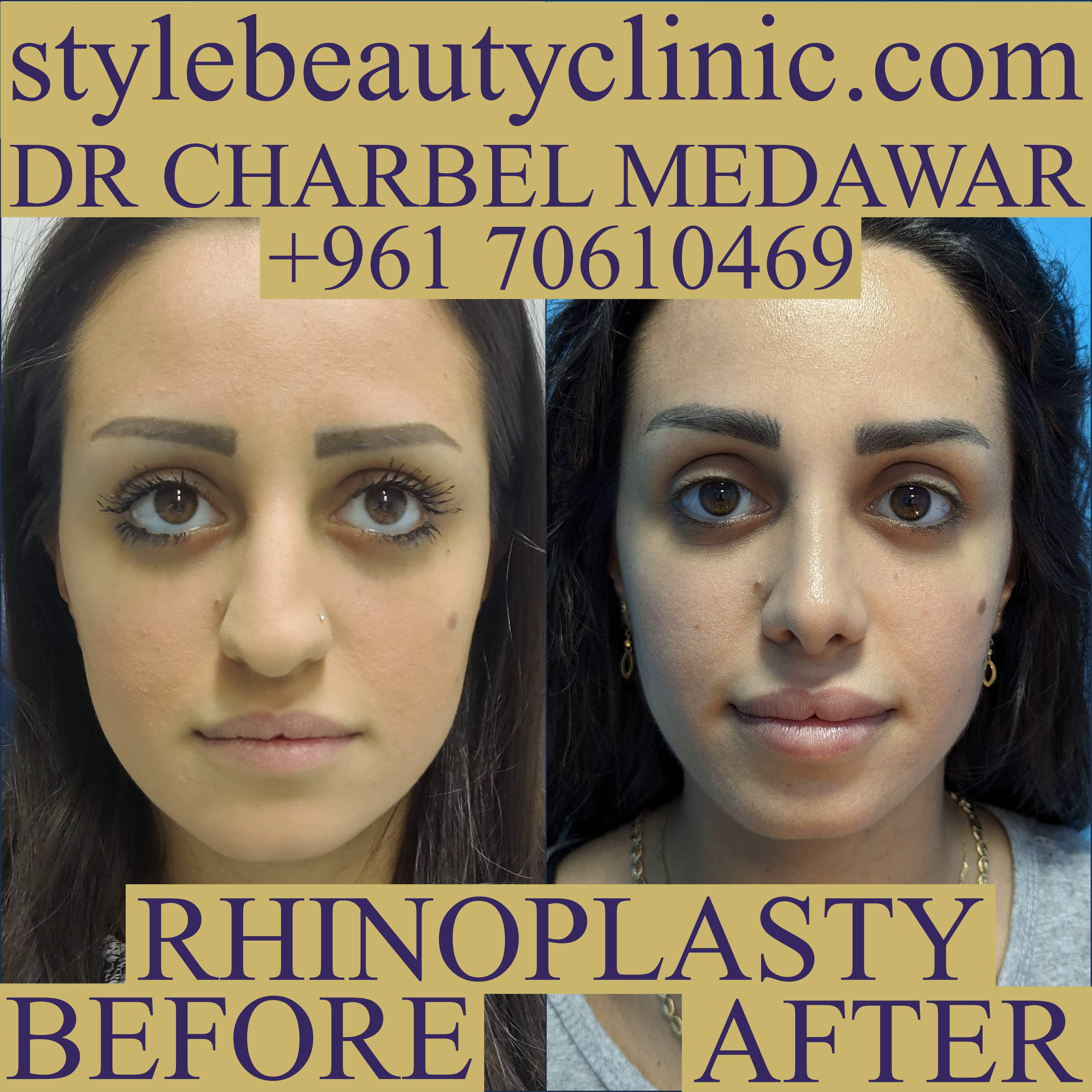 best nose plastic surgeon in lebanon