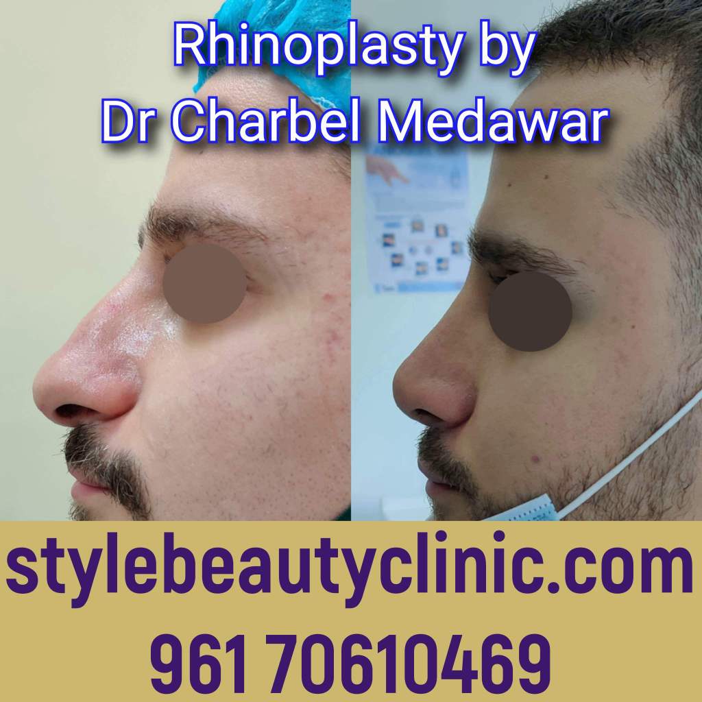 best nose plastic surgeon in lebanon dr charbel medawar