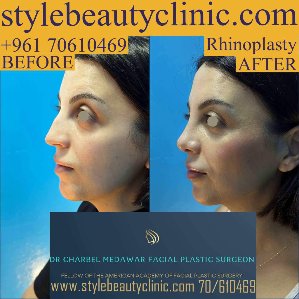 best nose plastic surgery lebanon