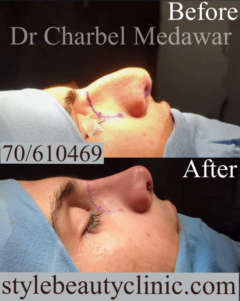 Ultrasonic Rhinoplasty Lebanon Dr Charbel Medawar Ultrasonic Rhinoplasty Lebanon Dr Charbel Medawar
