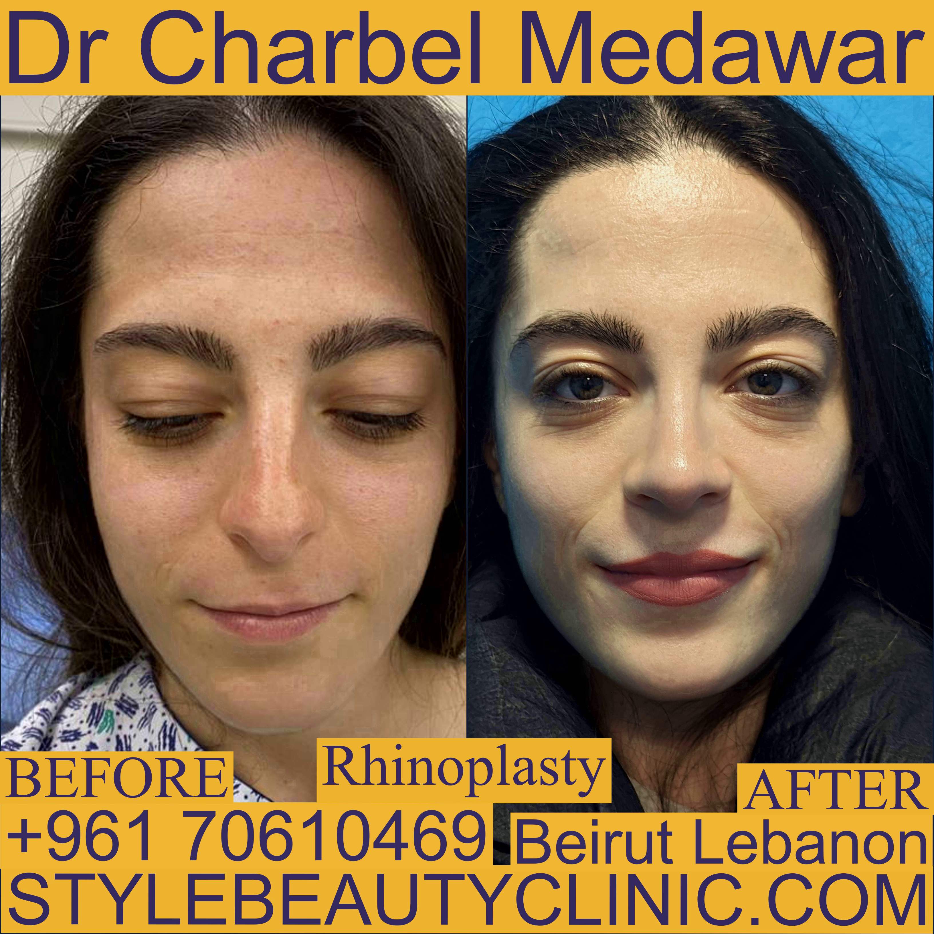 best nose surgery in lebanon dr charbel medawar