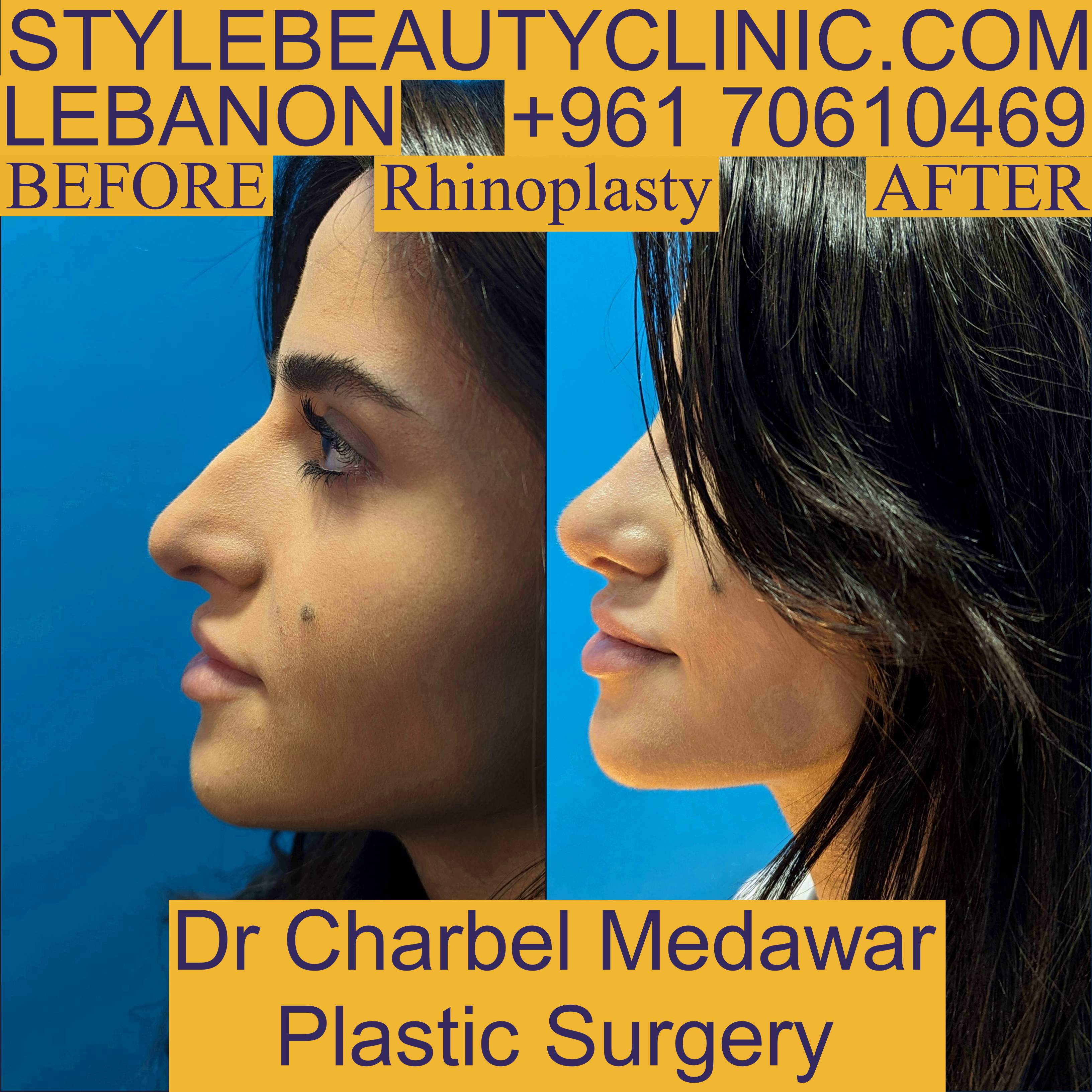 best rhinoplasty doctor in lebanon charbel medawar