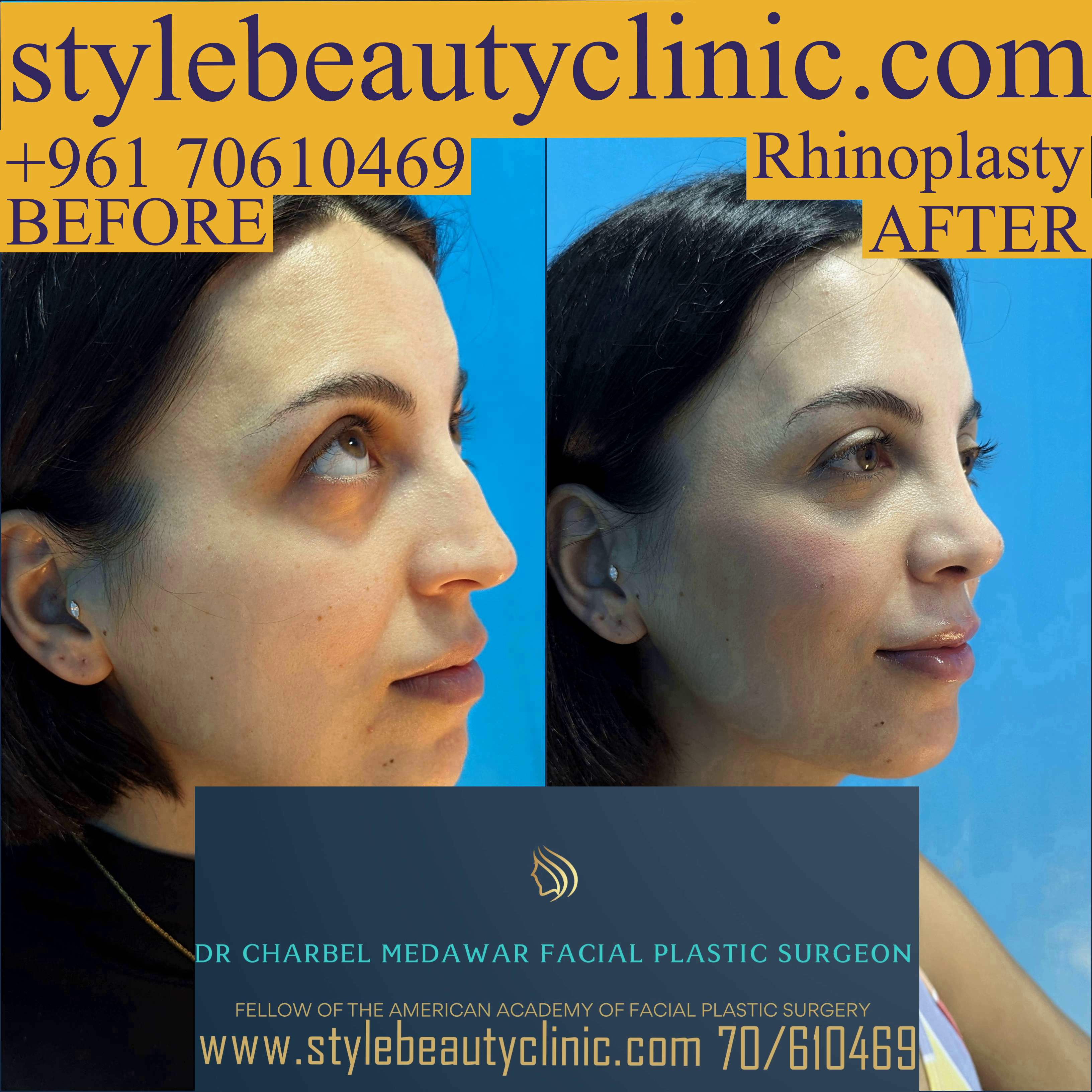 best rhinoplasty lebanon
