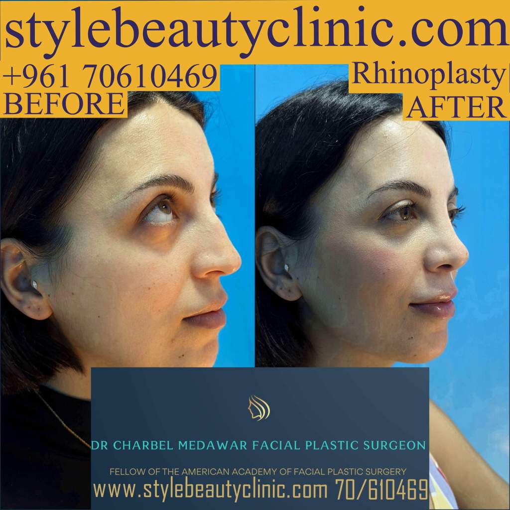 best rhinoplasty lebanon