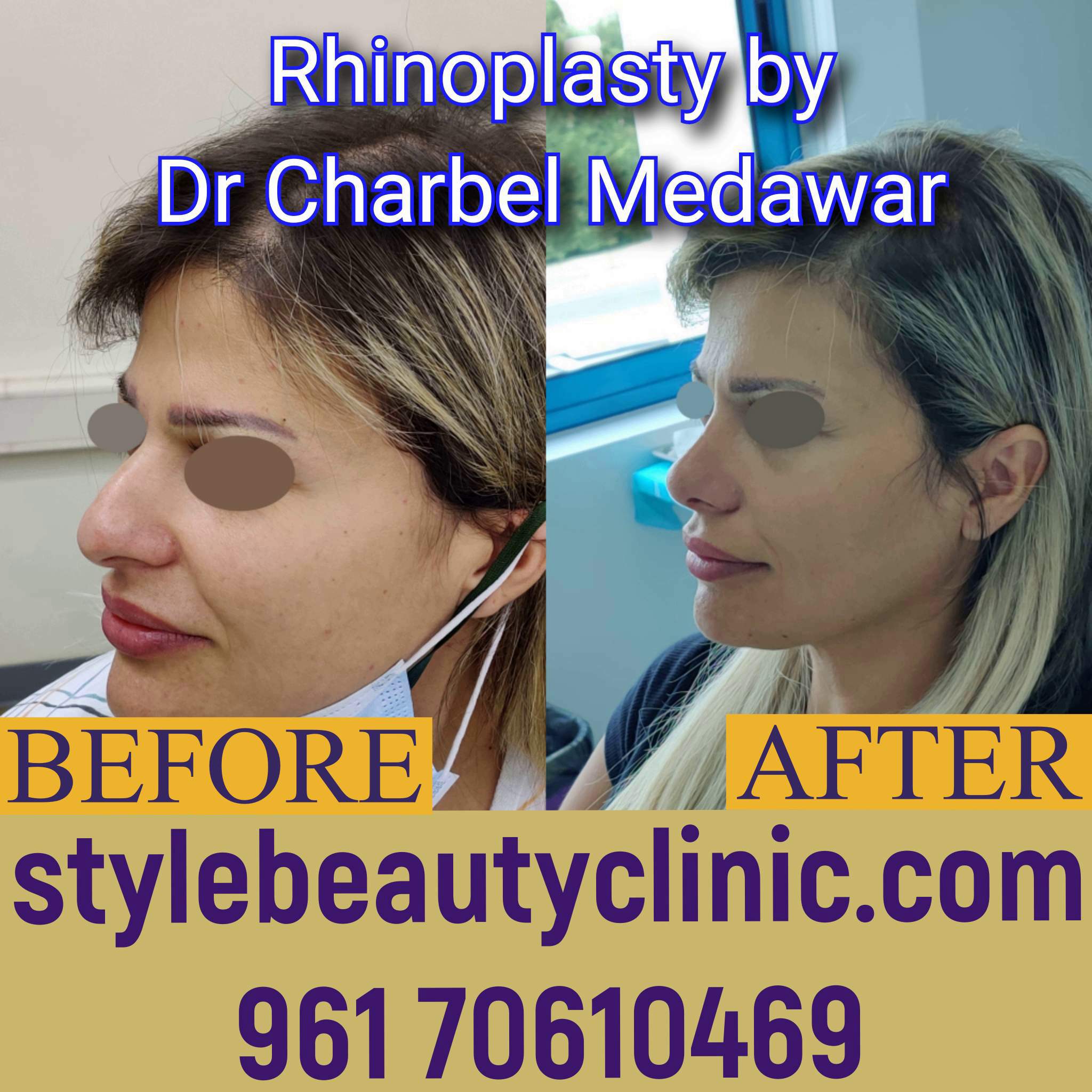 best rhinoplasty surgeon in beirut lebanon dr charbel medawar
