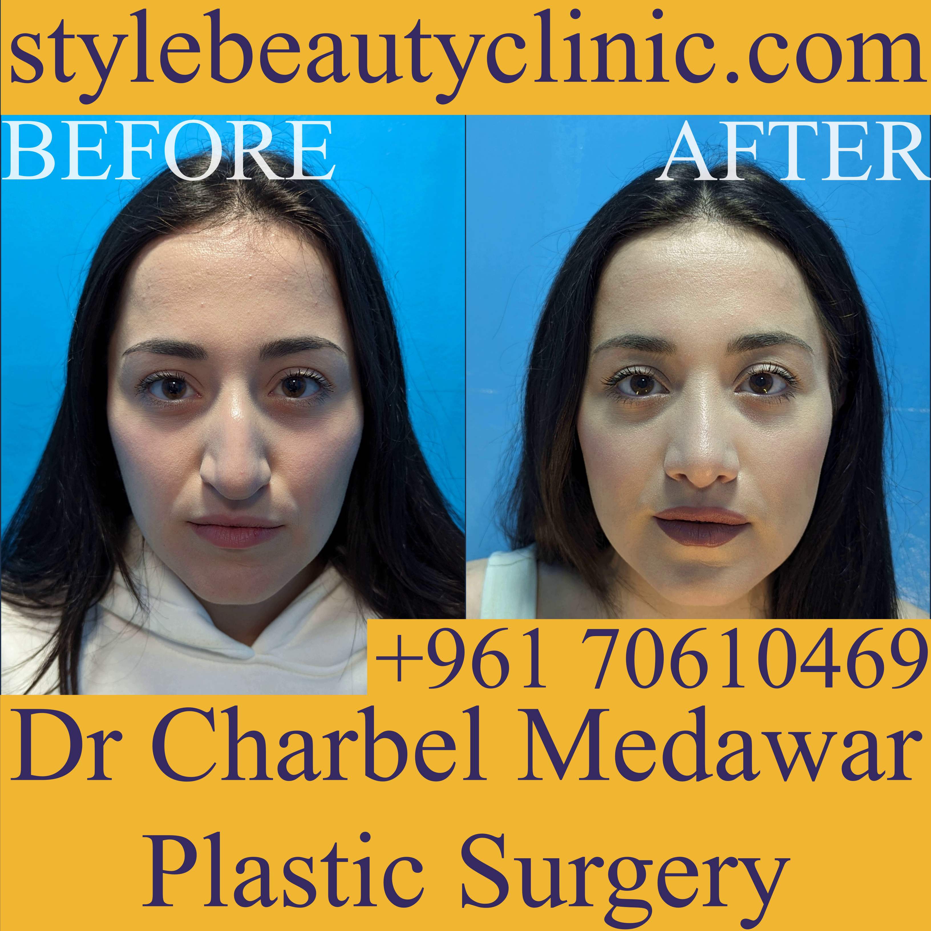best rhinoplasty surgeon lebanon