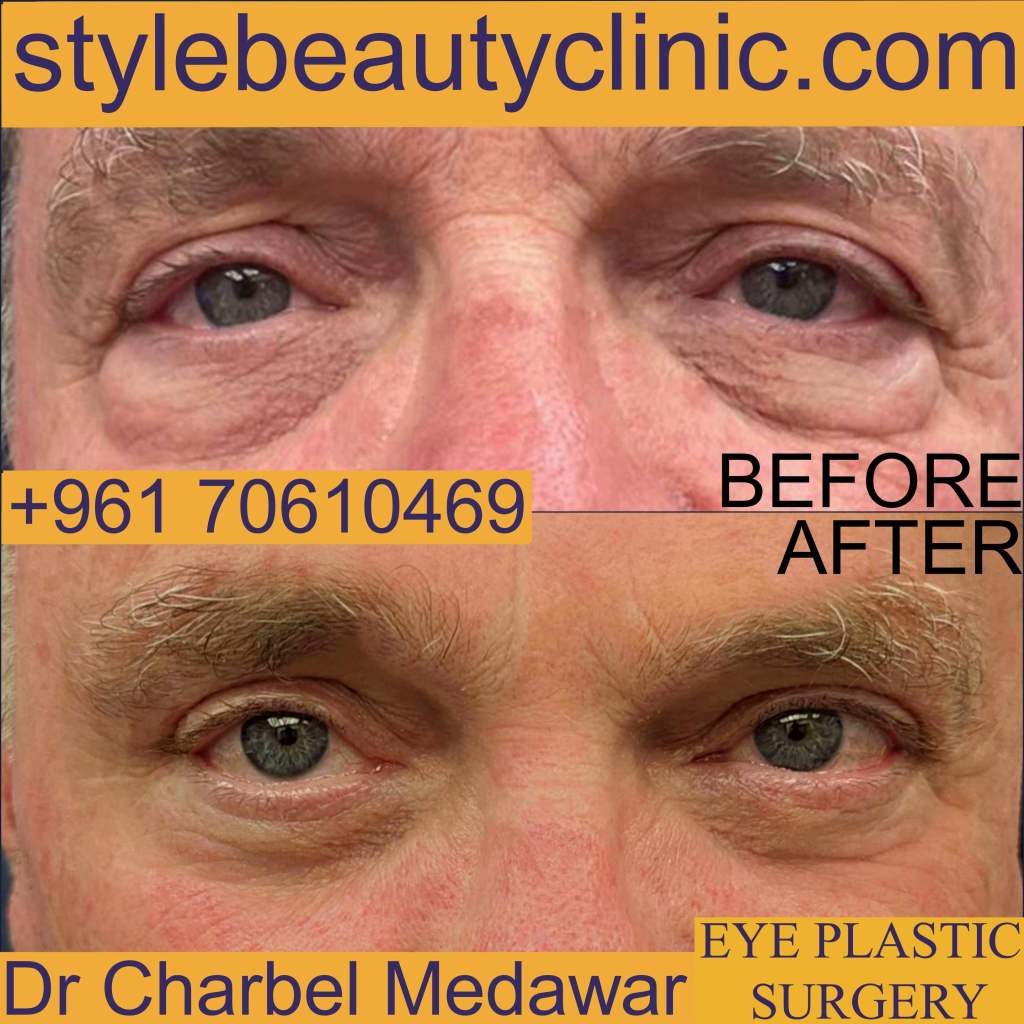 blepharoplasty dr charbel medawar style beauty clinic lebanon