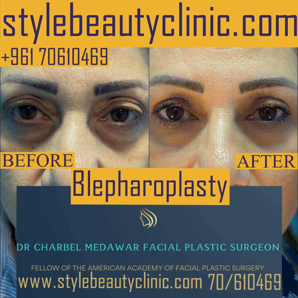 blepharoplasty plastic surgery in Lebanon dr charbel medawar