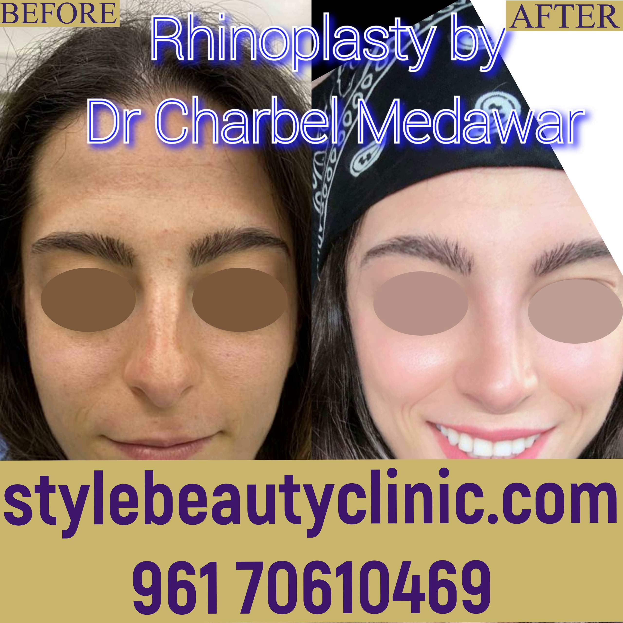dr charbel medawar best rhinoplasty surgeon in beirut lebanon