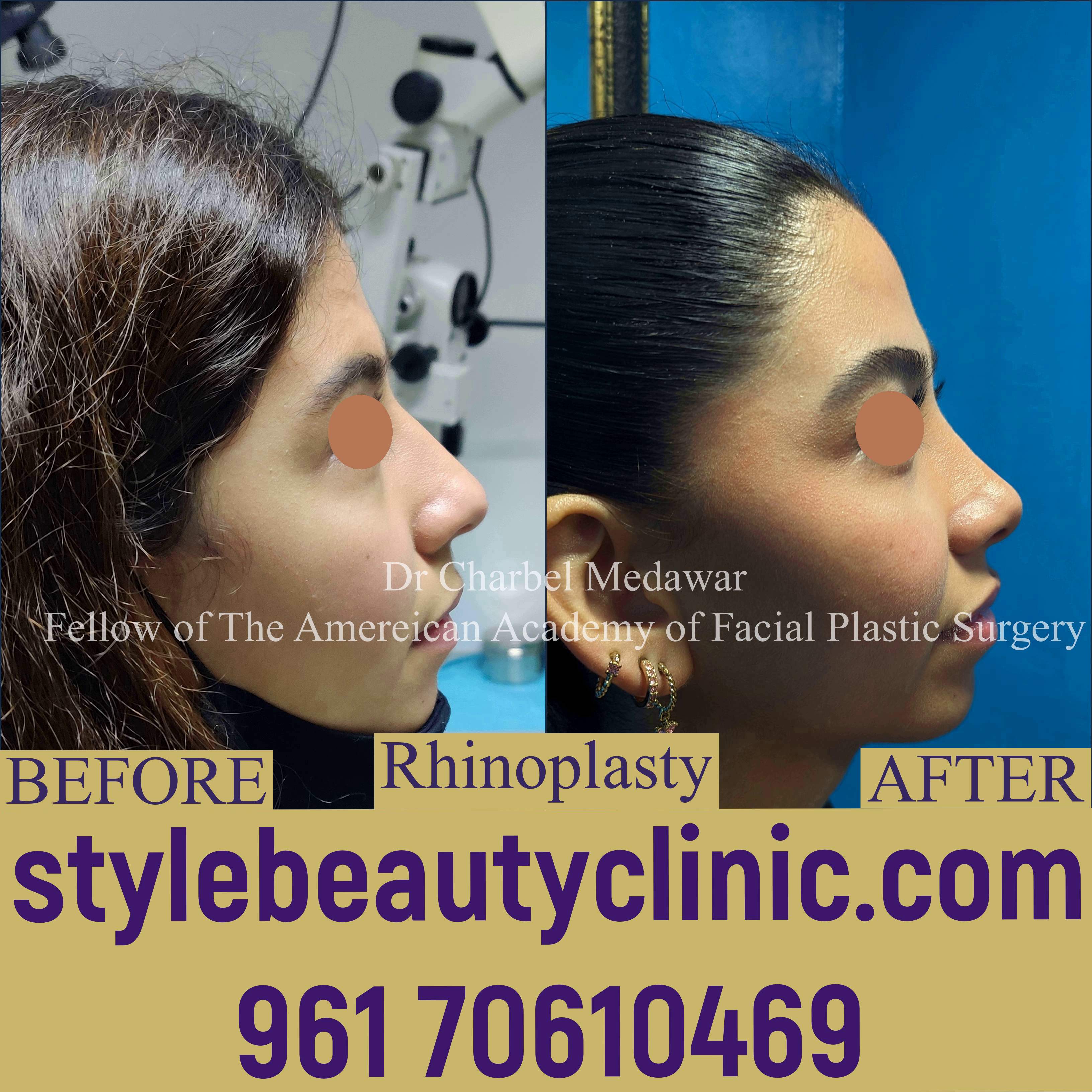 dr charbel medawar expert rhinoplasty lebanon