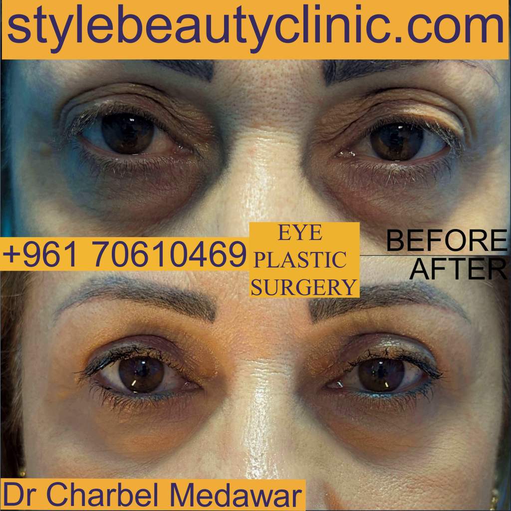 dr charbel medawar eye cosmetic surgery lebanon style beauty clinic