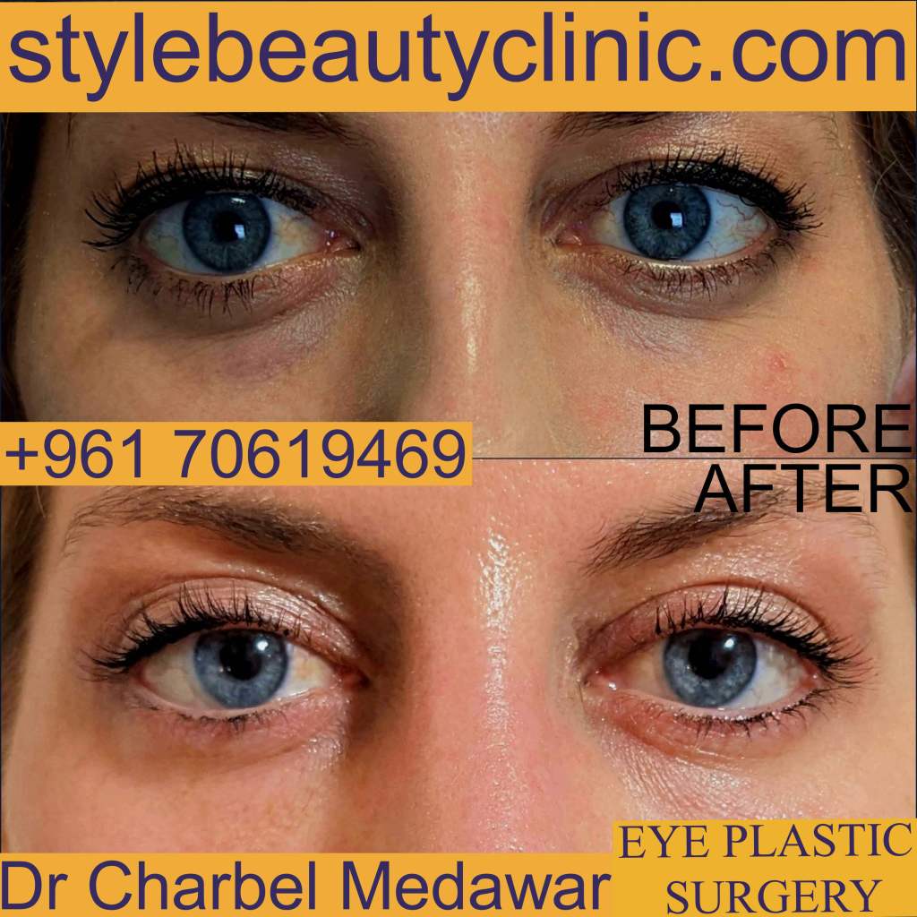 dr charbel medawar eyelid surgery lebanon