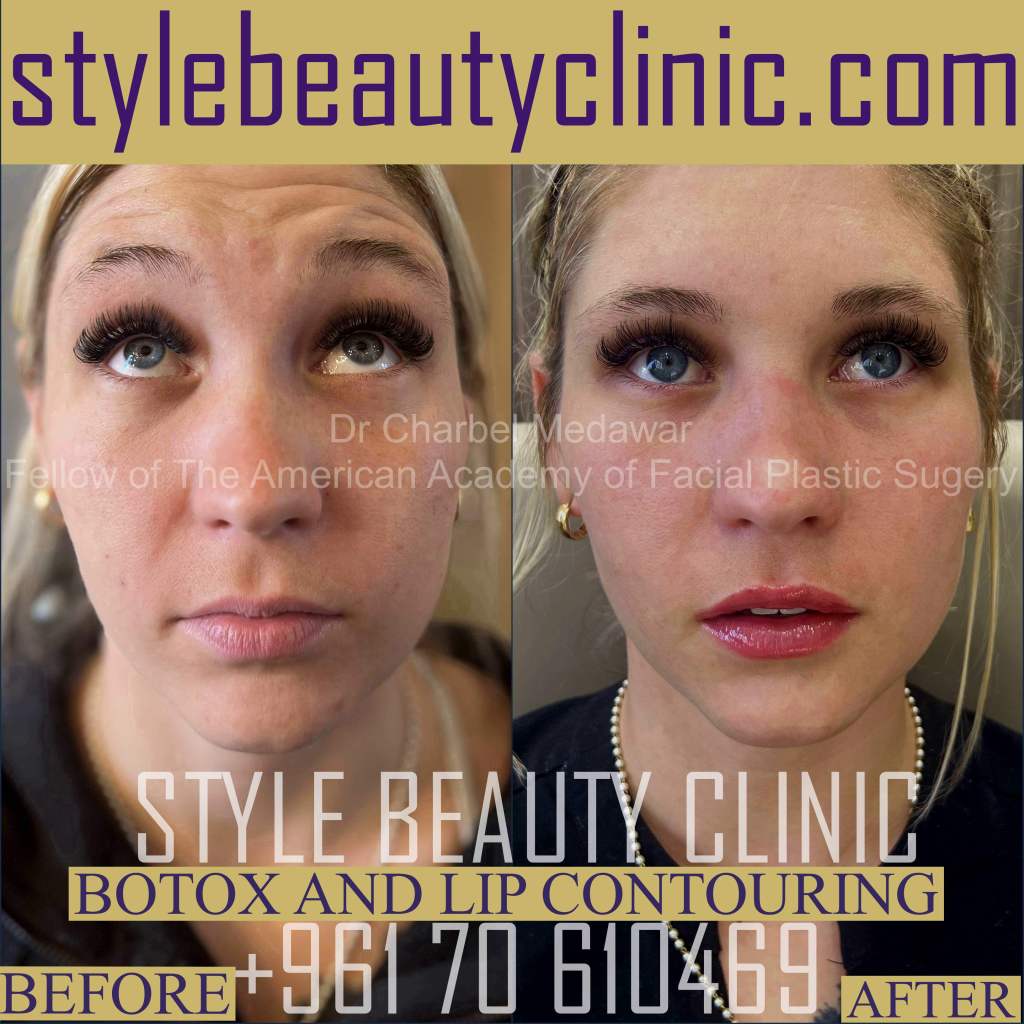 dr charbel medawar lip fillers botox beirut lebanon plastic surgery