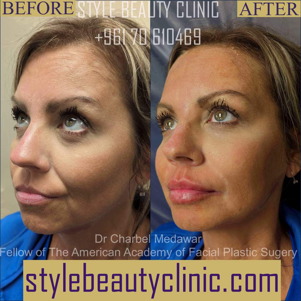 dr charbel medawar lips