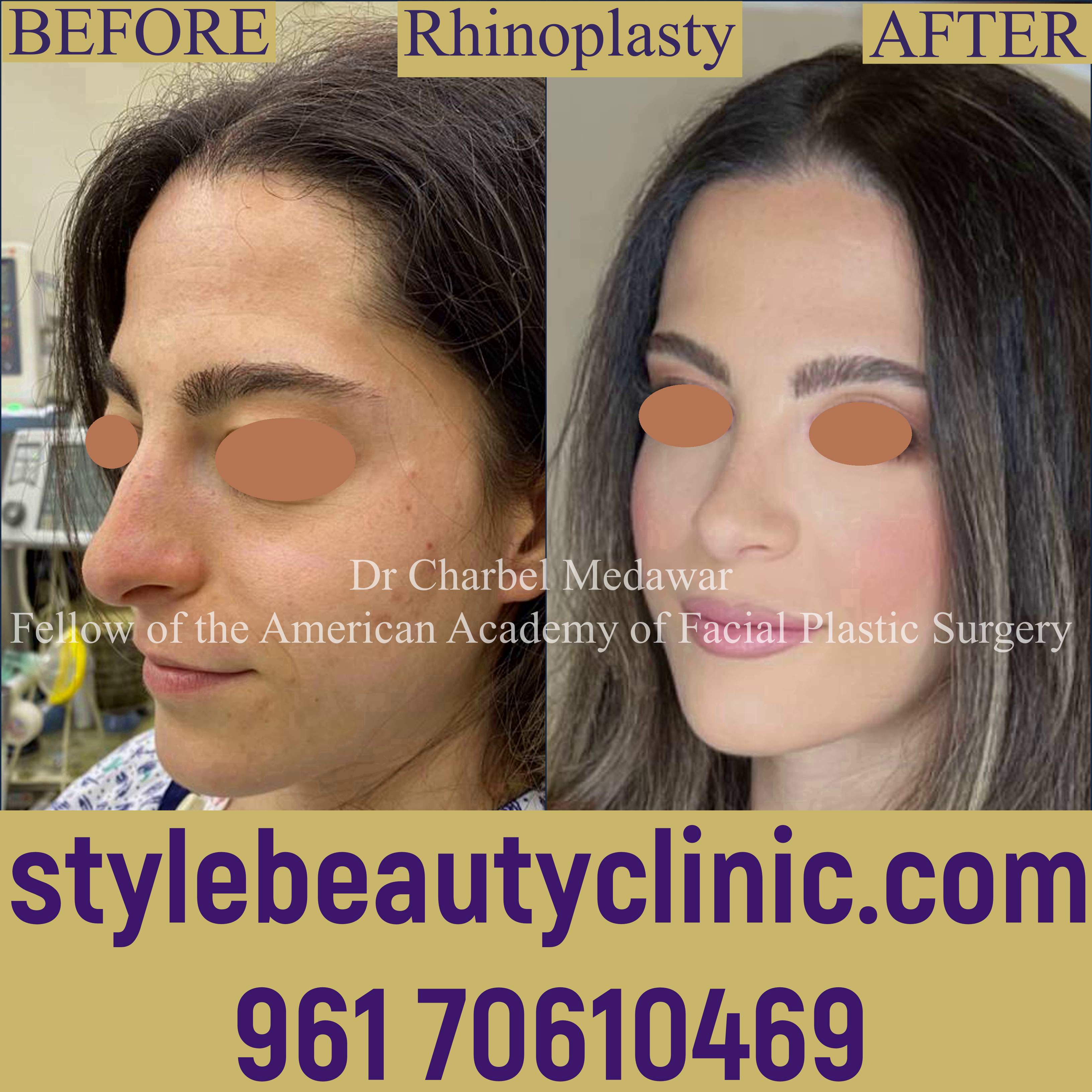 dr charbel medawar rhinoplasty master lebanon