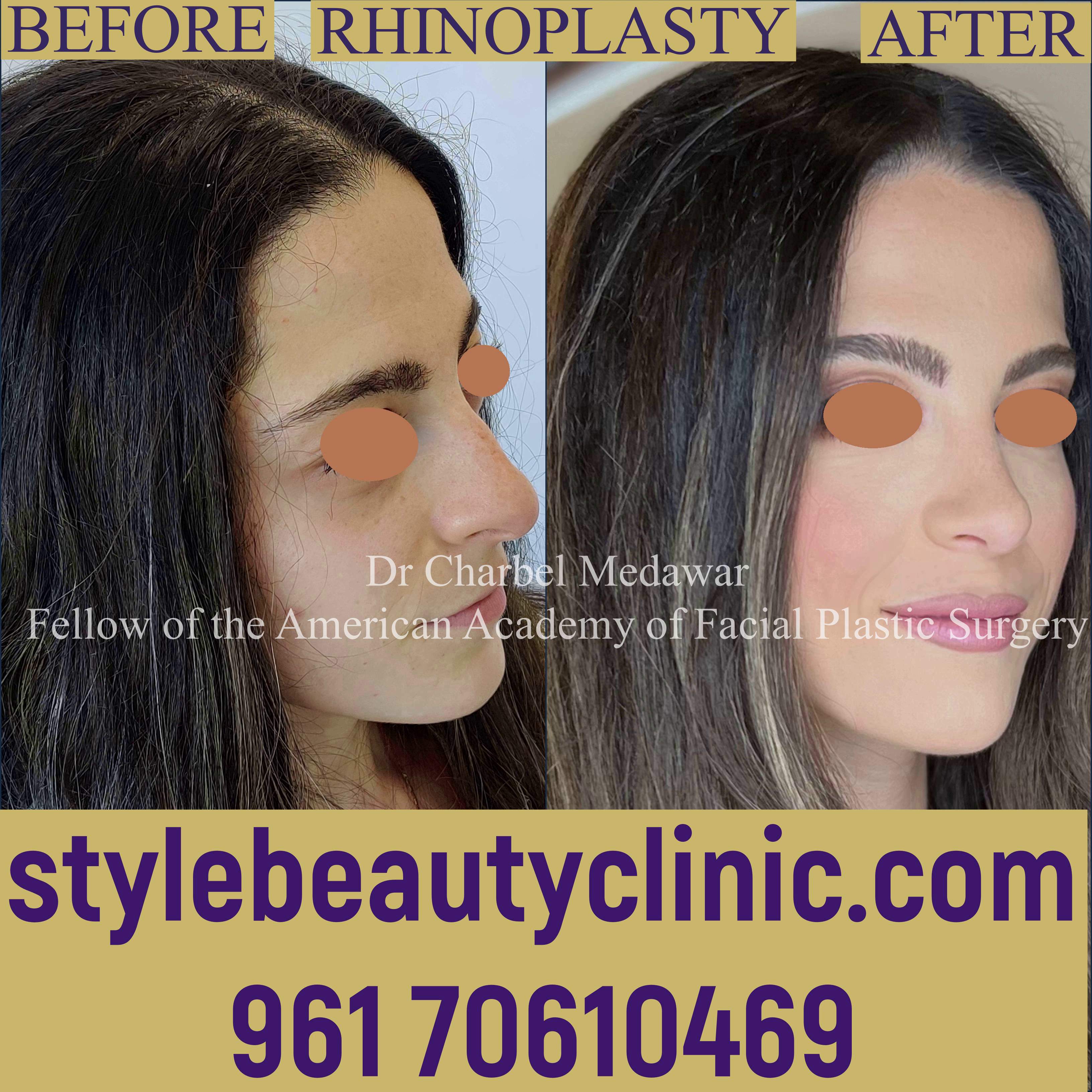 dr charbel medawar rhinoplasty specialist lebanon