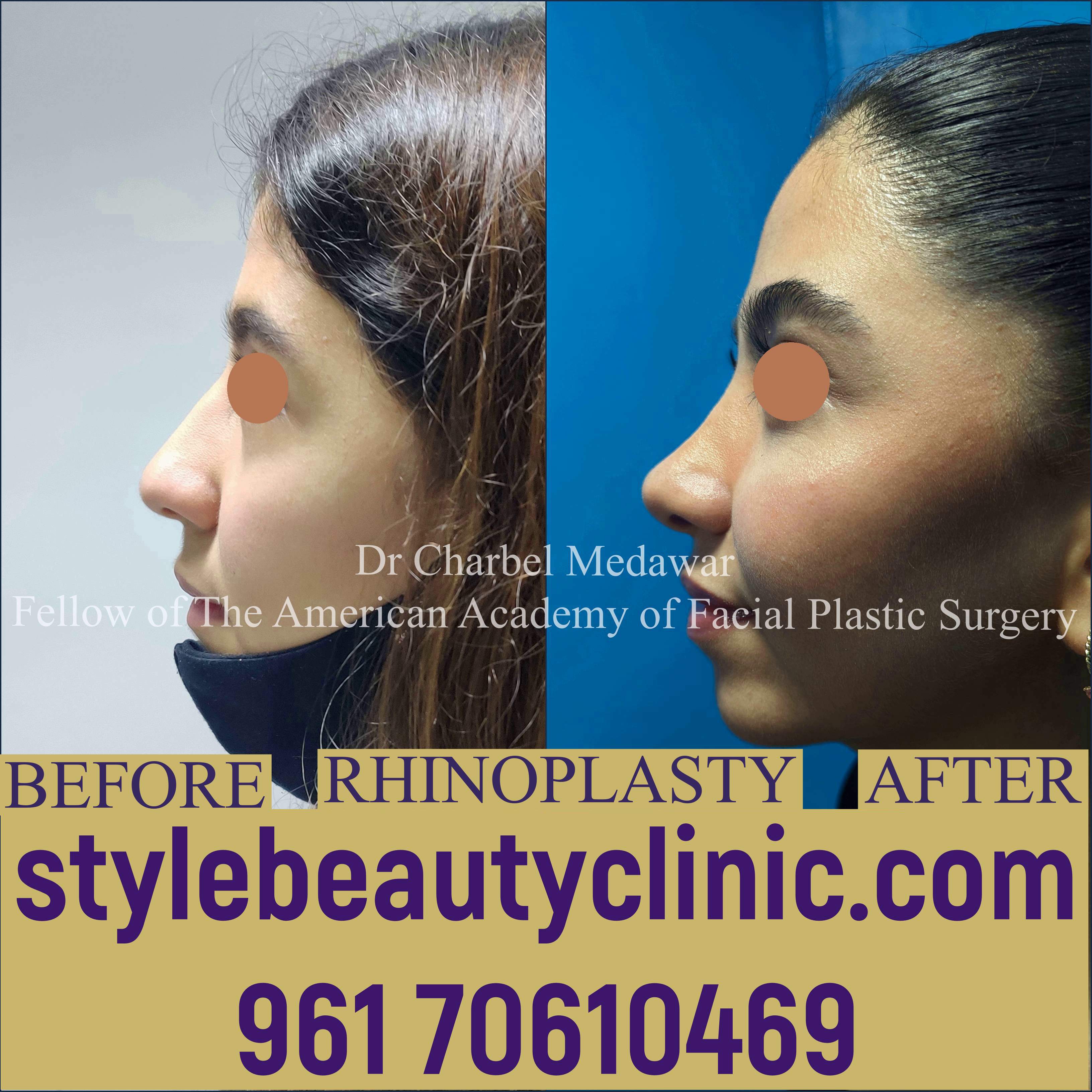 dr charbel medawar style beauty clinic best looking nose lebanon