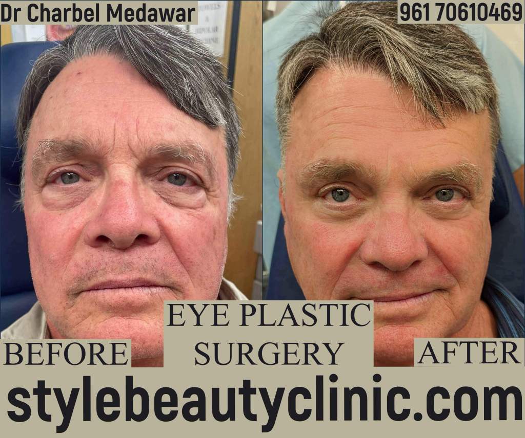 dr charbel medawar style beauty clinic blepharoplasty lebanon