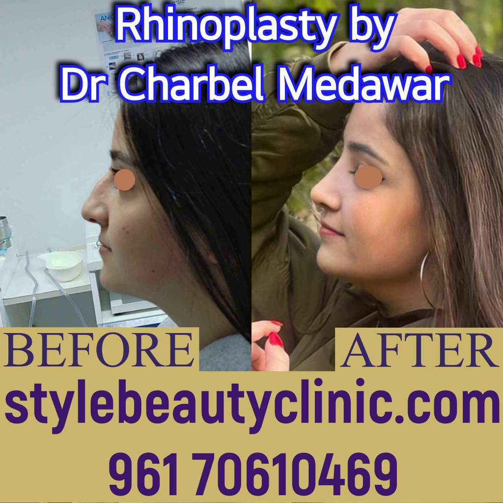dr charbel medawar style beauty clinic natural nosejob lebanon