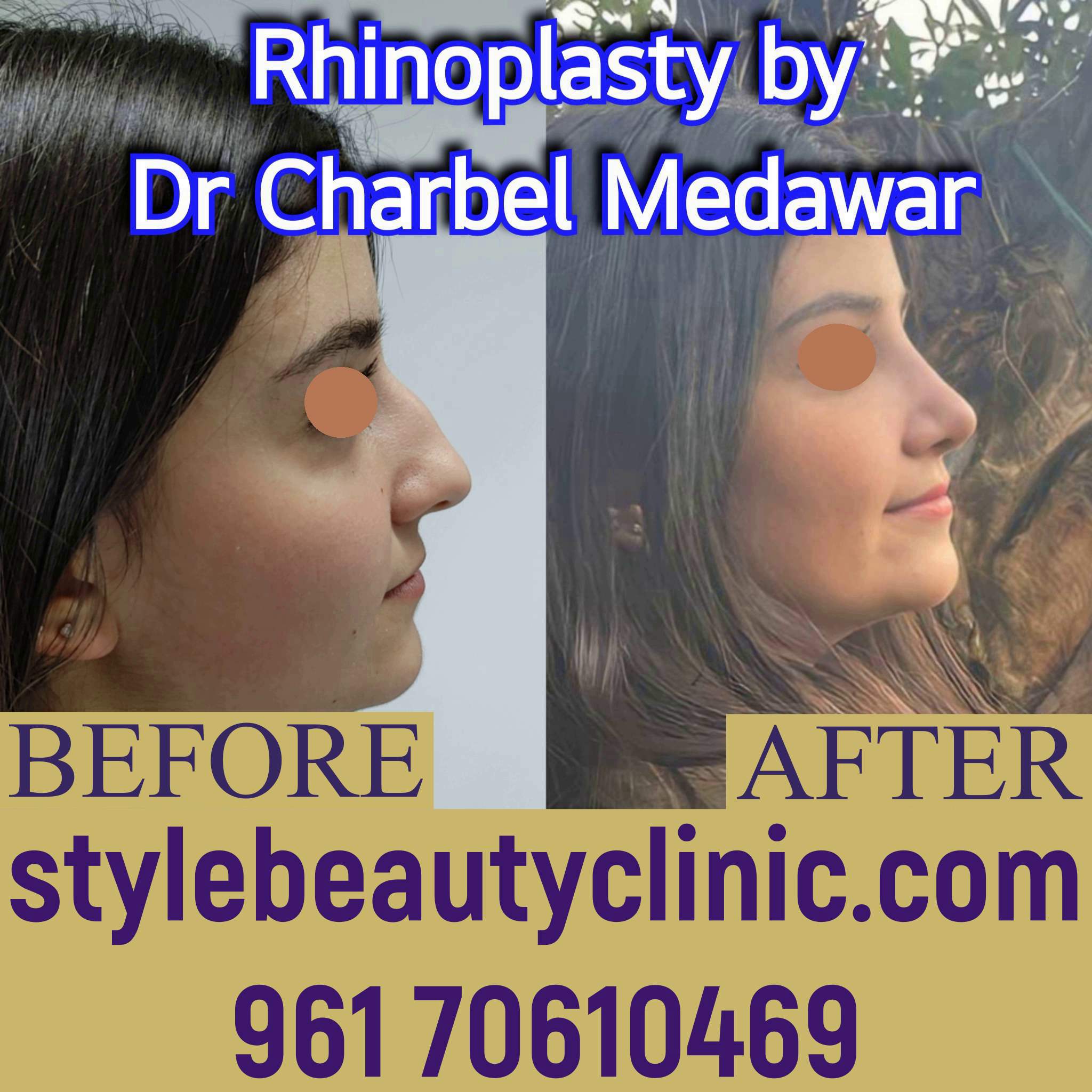 dr charbel medawar style beauty clinic natural rhinoplasty lebanon