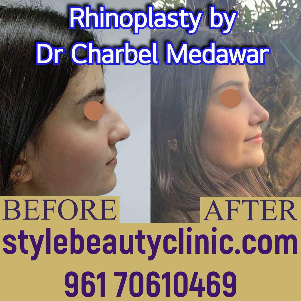 dr charbel medawar style beauty clinic natural rhinoplasty lebanon