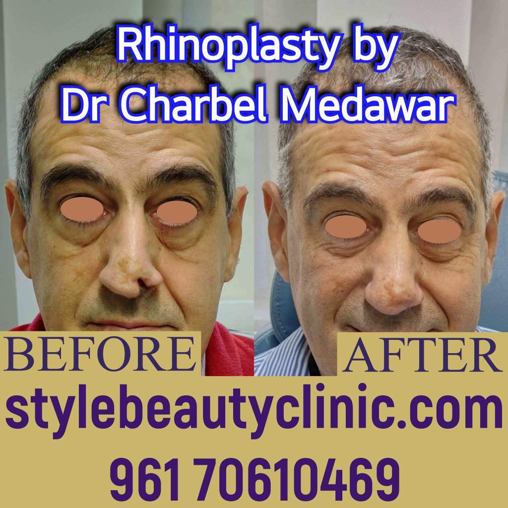 dr charbel medawar style beauty clinic reconstruction nose plastic surgery lebanon