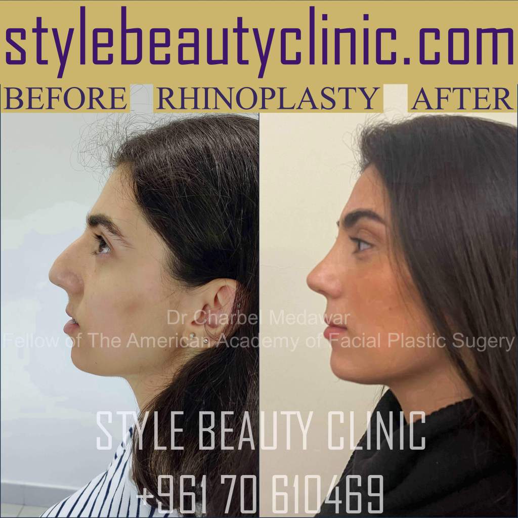 Best Ultrasonic Rhinoplasty Lebanon Dr Charbel Medawar Best Ultrasonic Rhinoplasty Lebanon Dr Charbel Medawar