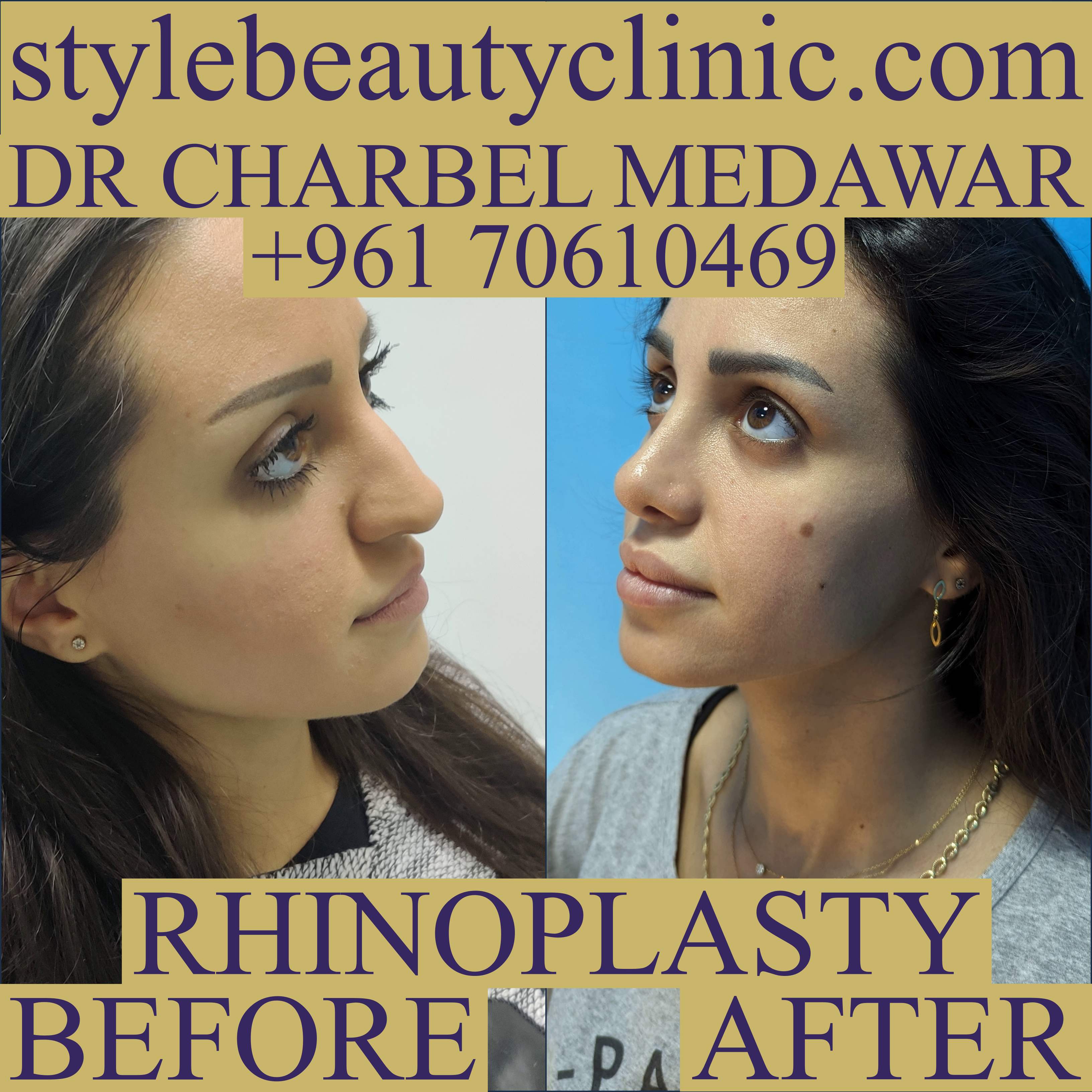 dr charbel medawar top rhinoplasty doctor in lebanon