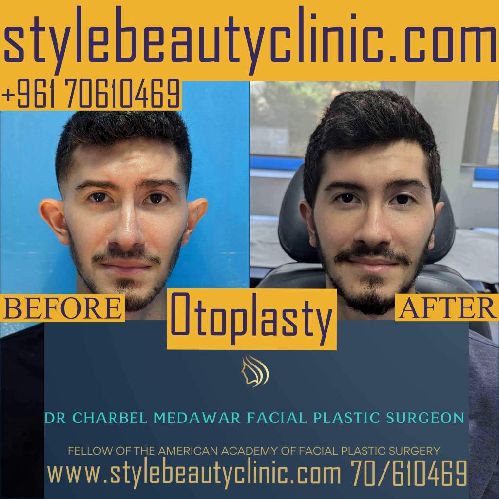 ear pinning surgery dr charbel medawar plastic surgery lebanon