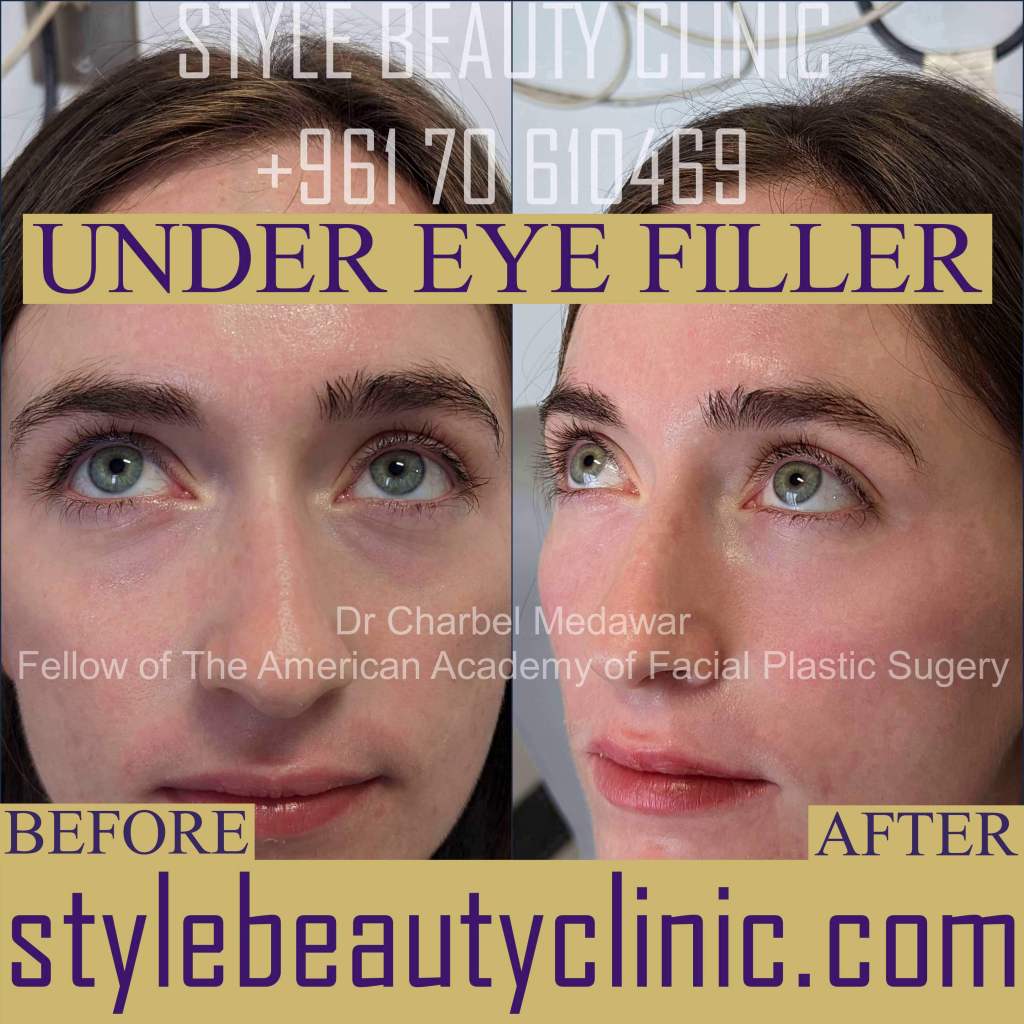 eyelid cosmetic surgery lebanon dr charbel medawar