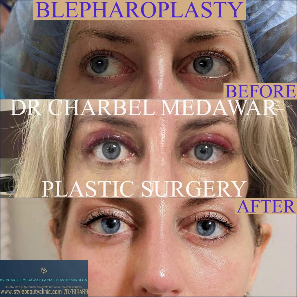 eyelid In Lebanon Prices dr charbel medawar