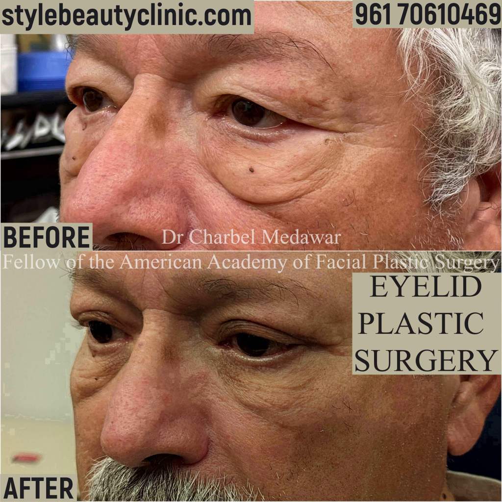 eyelid plastic surgery expert lebanon dr charbel medawar