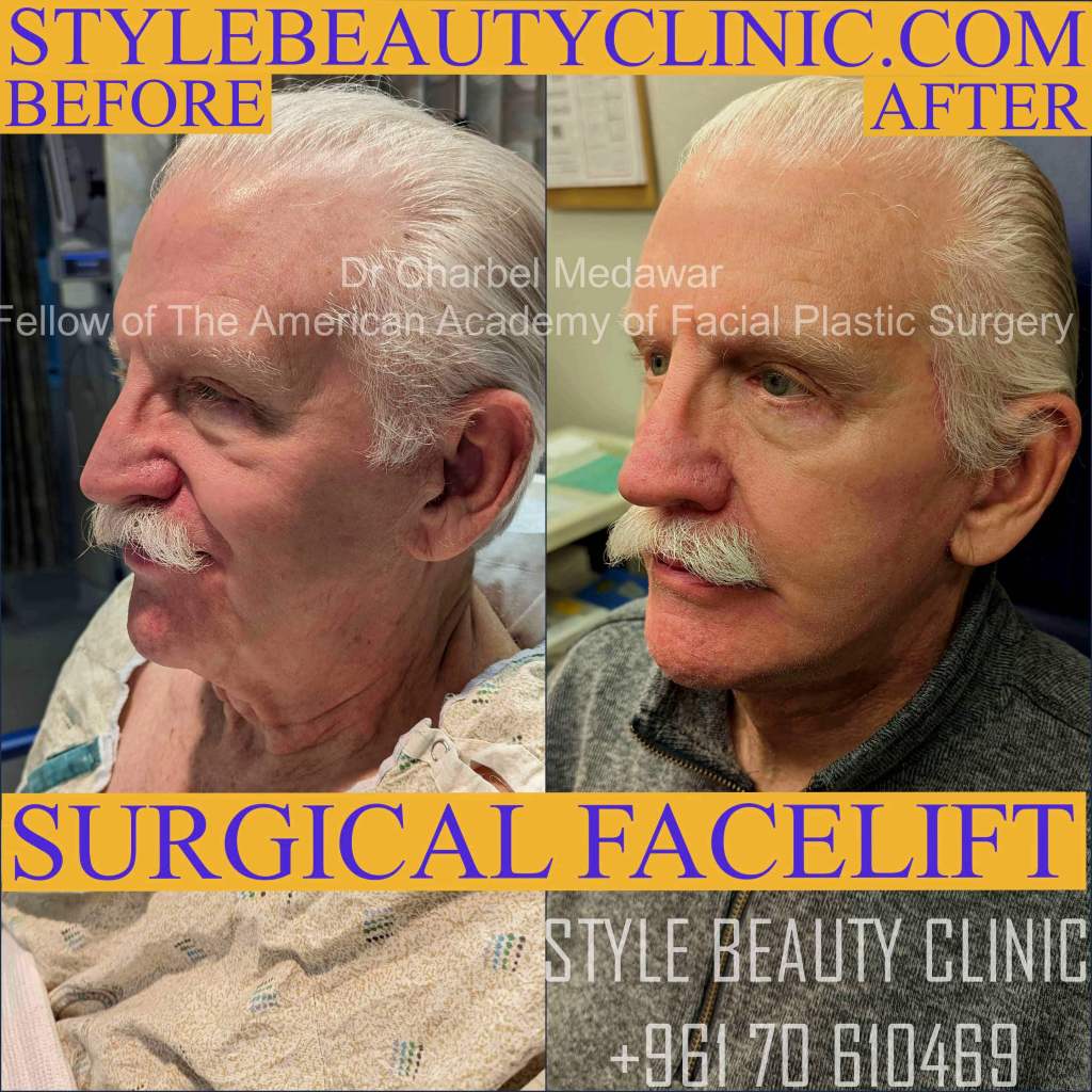 Best Facelift Surgeon In Lebanon dr charbel medawar Best Facelift Surgeon In Lebanon dr charbel medawar