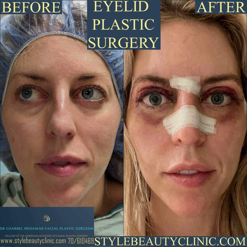 blepharoplasty surgery lebanon dr charbel medawar