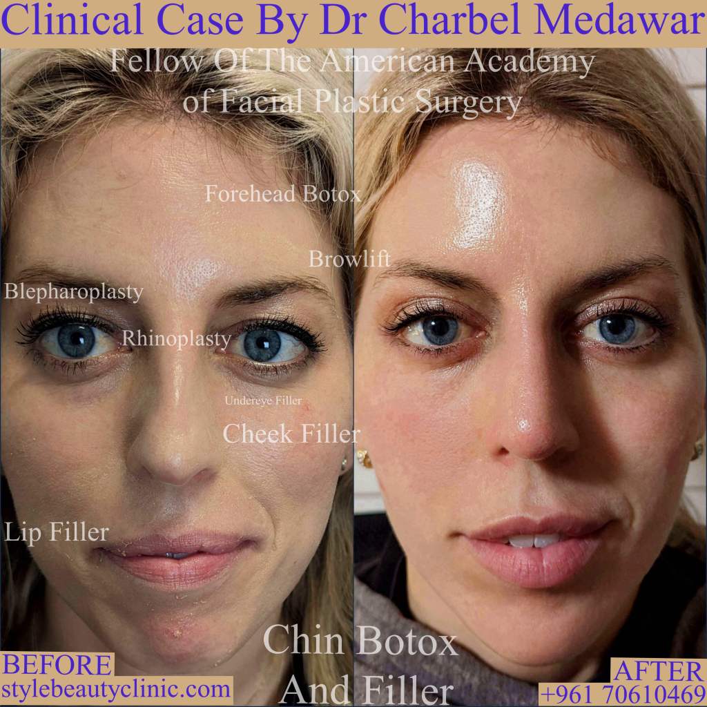 facial makeover beautification transformation by dr charbel medawar