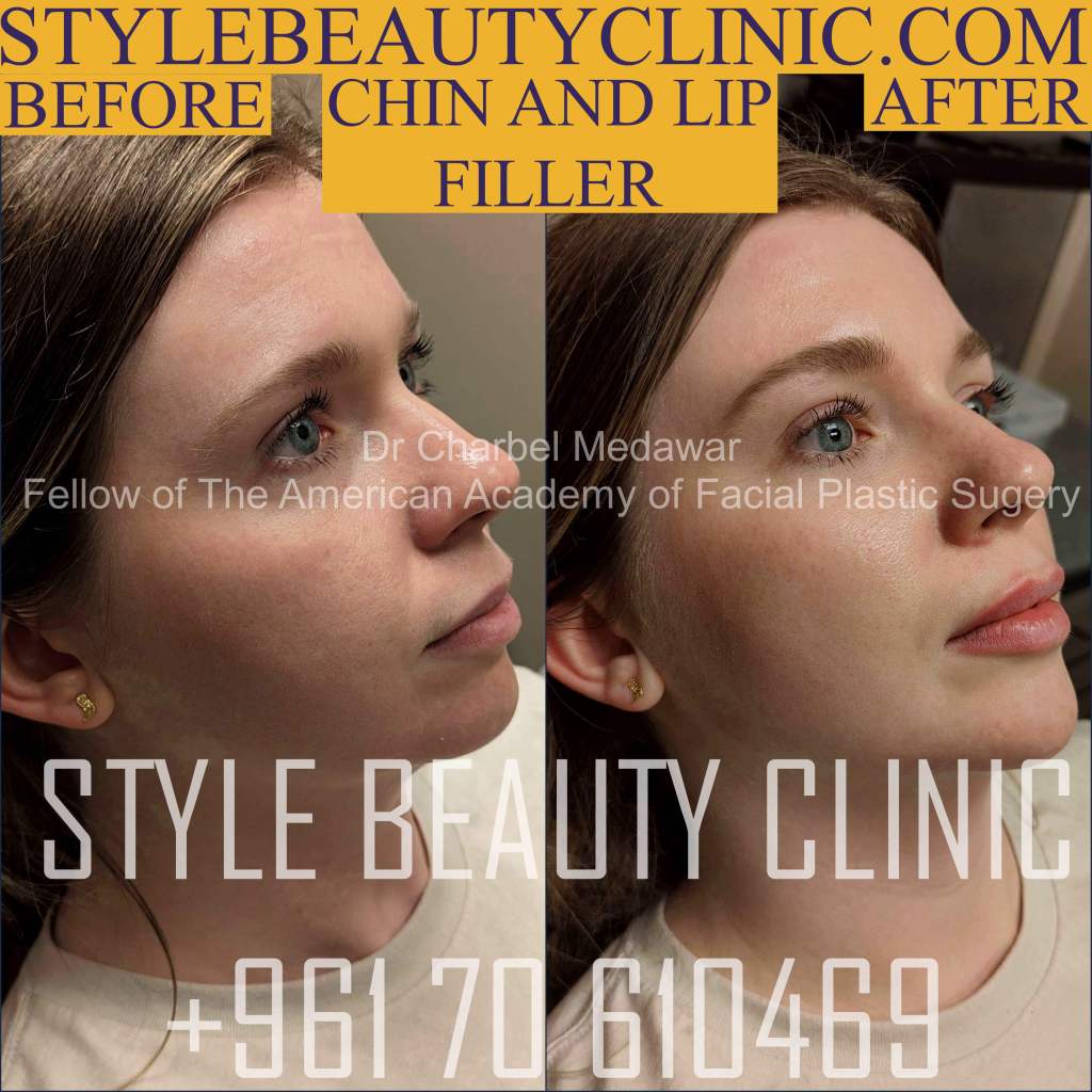 jawline chin filler contouring plastic surgery beirut lebanon
