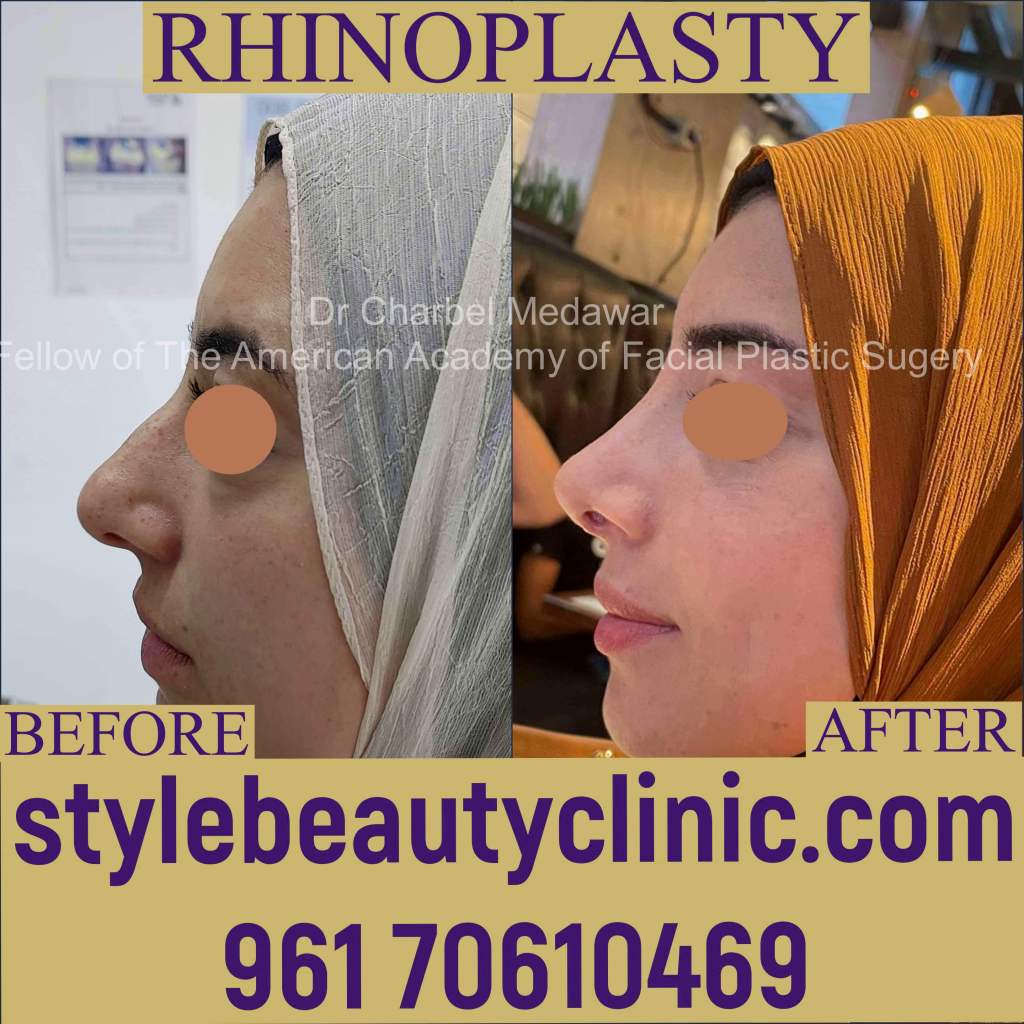 Top Ultrasonic Rhinoplasty Lebanon Dr Charbel Medawar Top Ultrasonic Rhinoplasty Lebanon Dr Charbel Medawar
