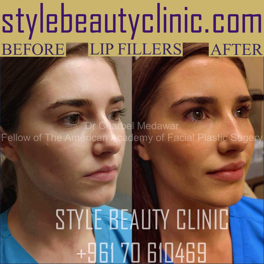 lip fillers beirut lebanon plastic surgery style beauty clinic dr charbel medawar