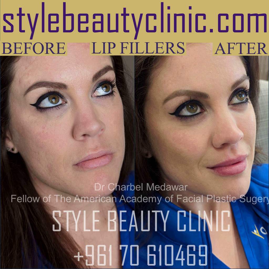 liquid facelift cheek lift jawline contouring lip dr charbel medawar plastic surgery beirut lebanon