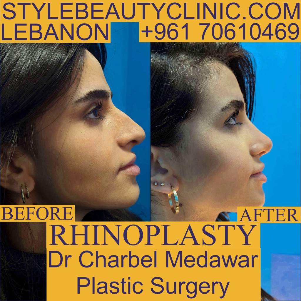dr charbel medawar Best rhinoplasty surgeon Lebanon