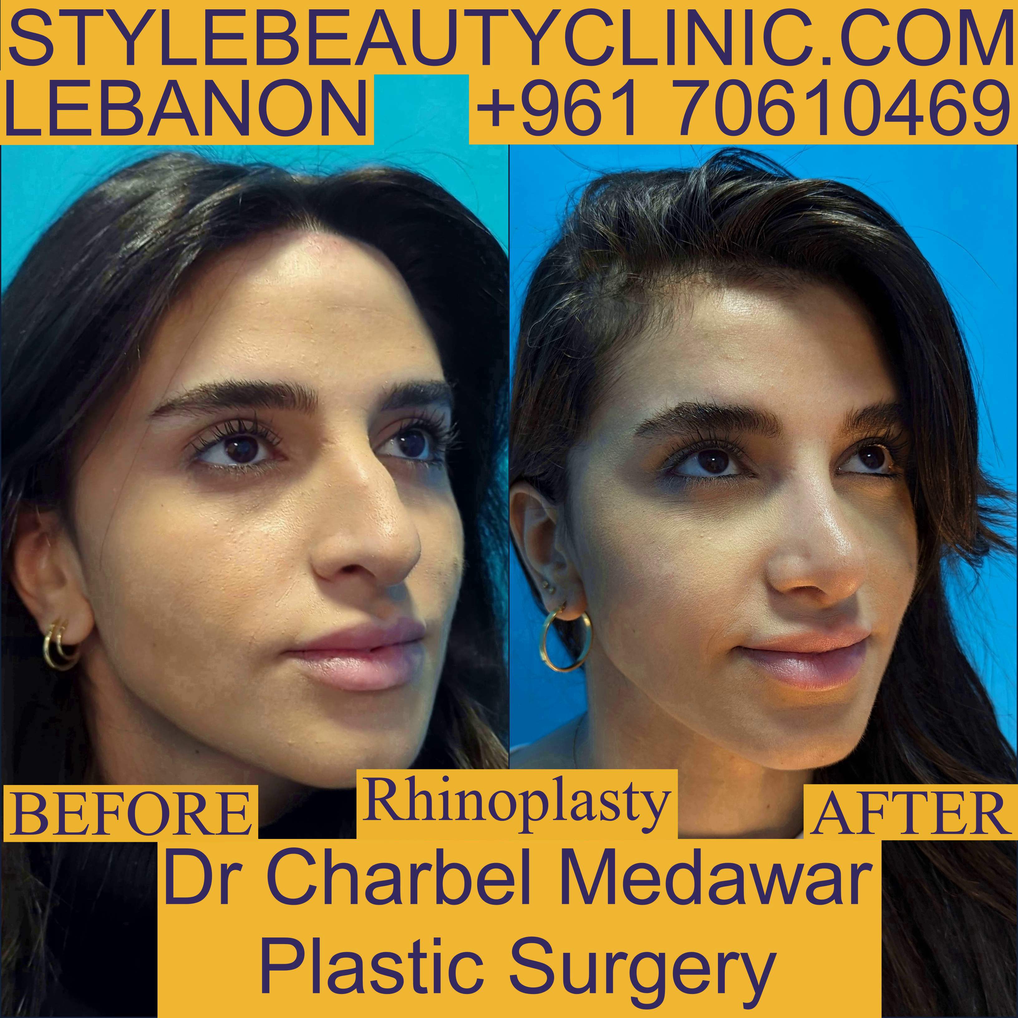 nose plastic surgery lebanon dr charbel medawar