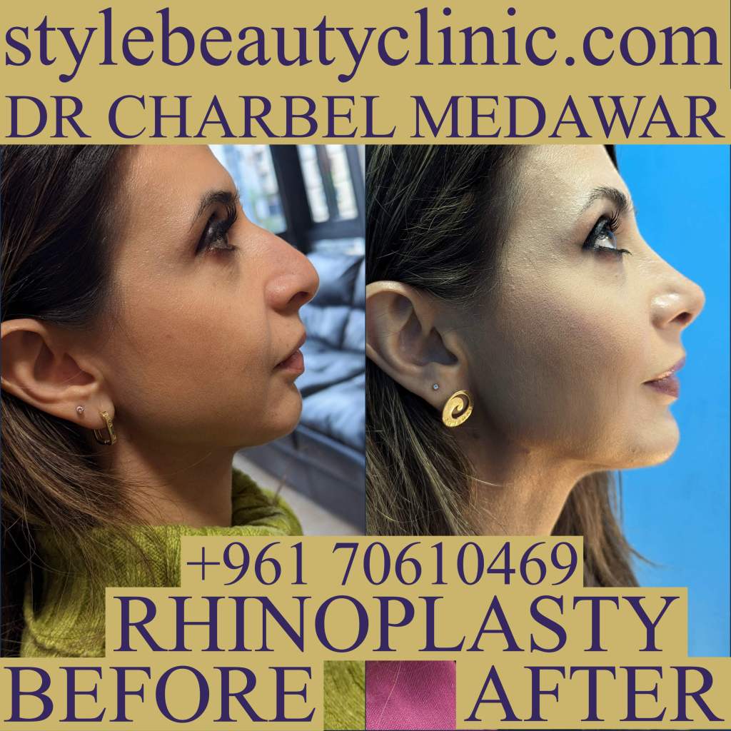 nose plastic surgery transformation lebanon dr charbel medawar